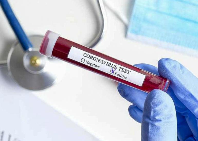Azərbaycanda indiyədək 3 414 614 koronavirus testi aparılıb