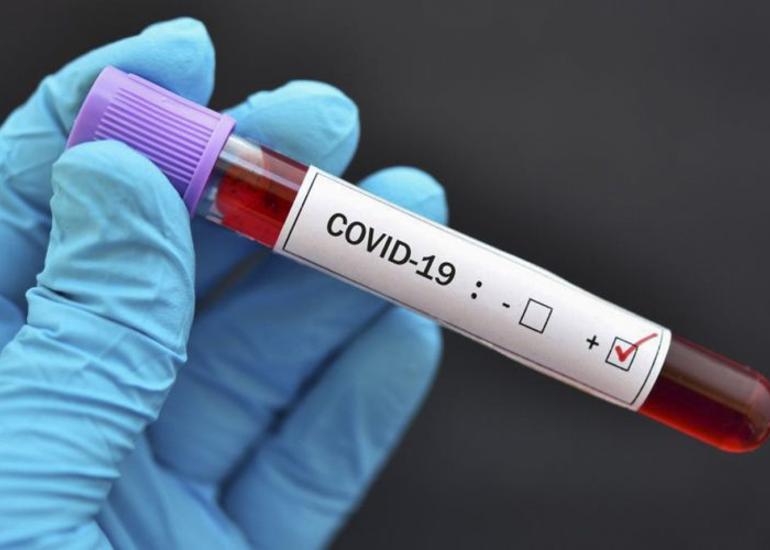 Gürcüstanda koronavirusa daha 133 yoluxma qeydə alınıb